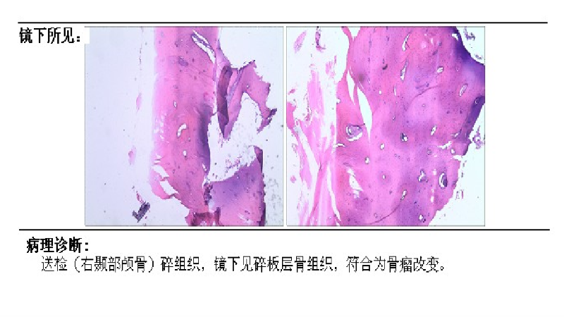 骨瘤.png