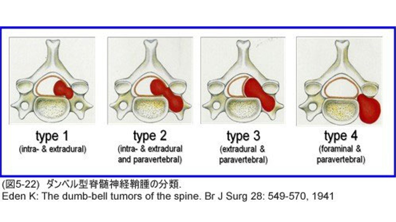 椎管内神经鞘瘤.jpg
