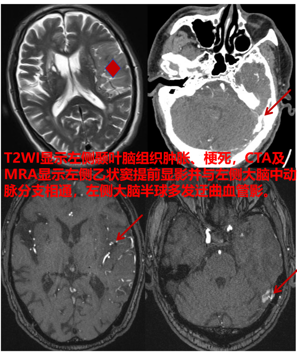 硬脑膜动静脉瘘-中国医学影像联盟-China Medical Imaging Association