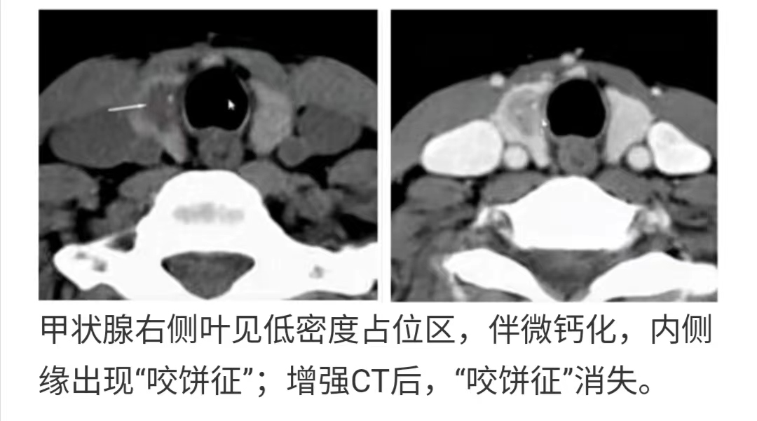 咬饼征-甲状腺乳头状癌-中国医学影像联盟-China Medical Imaging Association