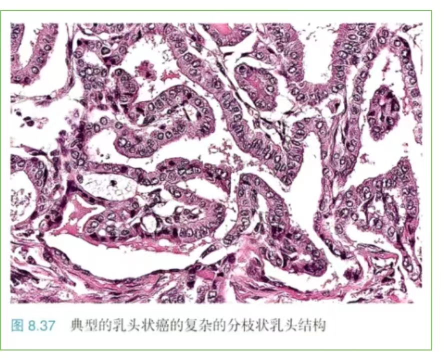 咬饼征-甲状腺乳头状癌-中国医学影像联盟-China Medical Imaging Association