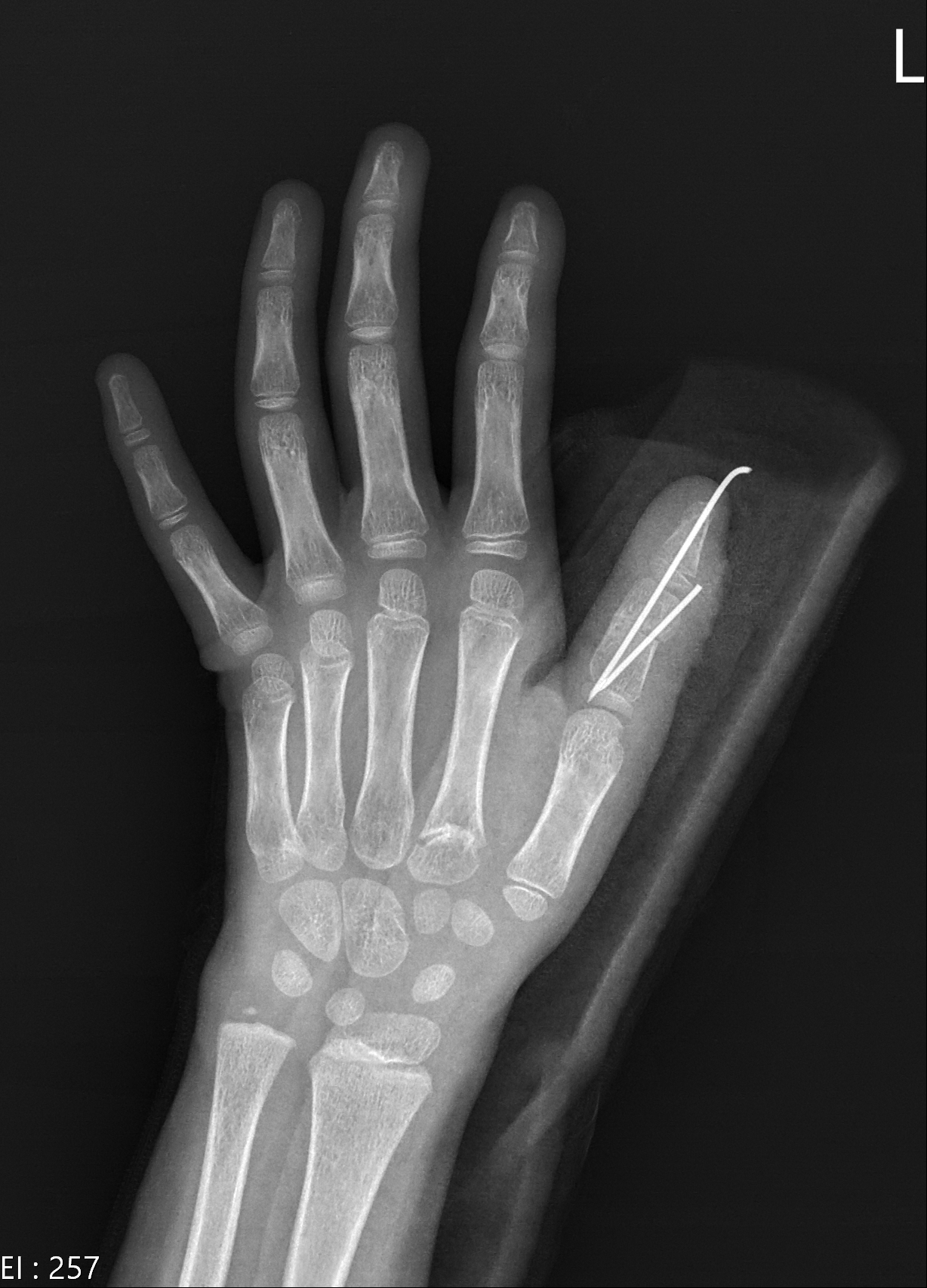 其实“并”不容易,分“手”也不简单(先天性并指)-中国医学影像联盟-China Medical Imaging Association