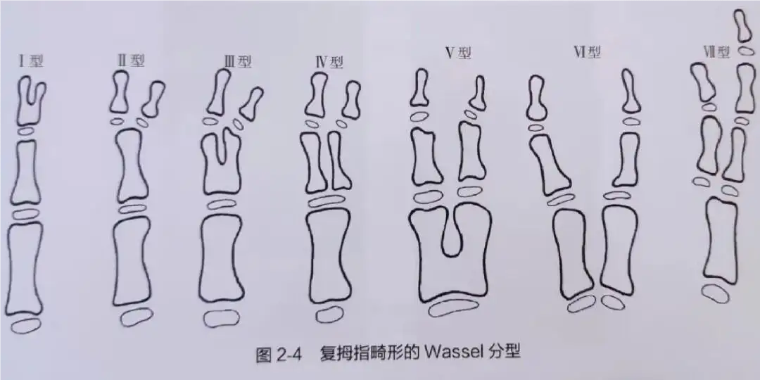 其实“并”不容易,分“手”也不简单(先天性并指)-中国医学影像联盟-China Medical Imaging Association