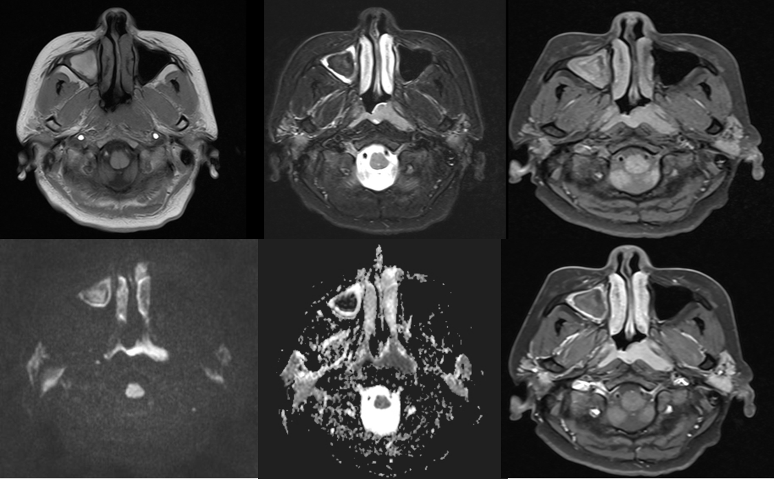 鼻咽非角化性鳞状细胞癌-中国医学影像联盟-China Medical Imaging Association